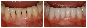 Foto: abans i després de la restauració de dents amb xapes
