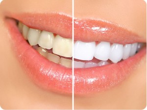 Foto: Dentes antes e depois do clareamento