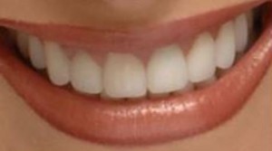 Photo: Ceramic veneers on front teeth