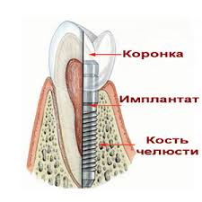 Foto: struktura implantata