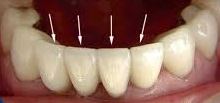 Nuotrauka: Fanera ant apatinių dantų