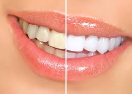 Photo: Dents après restauration avec des facettes