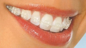 Photo: Bretelles pour l'alignement des dents