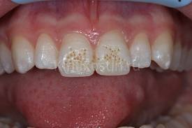 Foto: Presença de manchas nos dentes da frente