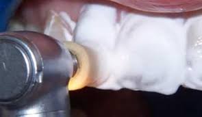 Foto: pulizia della superficie dei denti prima del restauro
