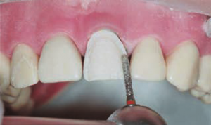 Foto: Klargøring af en tand til finer