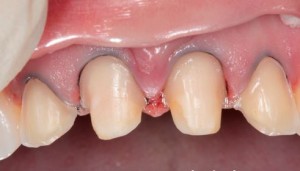 Foto: Preparació de dents sota corones