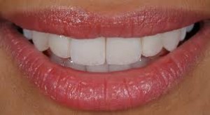 Kuva: Hampaat viilun restauroinnin jälkeen