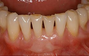 veneers on lower teeth before