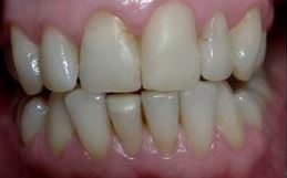 veneers for lower teeth do1