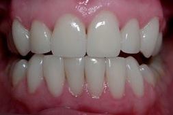 carillas en los dientes inferiores después de1