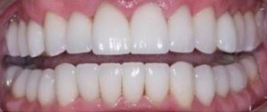 xapes en dents inferiors després