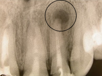 الصورة: كيس من جذر الأسنان في الأشعة السينية