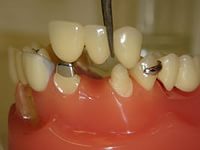 Foto: proteză dentară