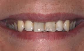 Foto: manchas escuras nos dentes