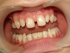 الصورة: وجود فجوات بين الأسنان