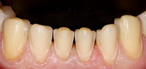 Foto: Dentes inferiores após preparação para facetas