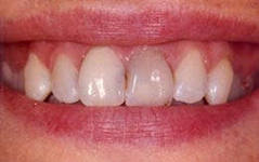 Foto: verdonkering van tandglazuur
