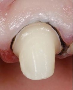 Foto: Um fio entre um dente e uma gengiva para impressionar