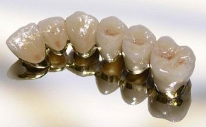 Foto: corones dentals de ceràmica-metall