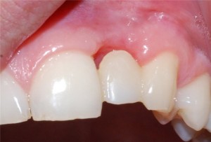 Foto: Prótese temporária do dente superior