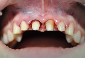 Photo: Teeth turned on zirconium crowns