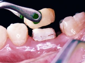 Foto: Cimentação de uma coroa dentária
