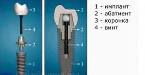 Photo: Screw fixation of a crown on an implant