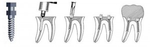 Gambar: Pemulihan gigi dengan pin anchor