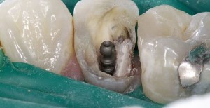 Foto: restauración dental con un alfiler