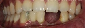 Foto: Restauratie van tanden van de onderkaak door cermet tot