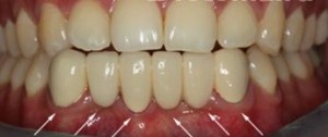 Foto: Herstel van tanden van de onderkaak door cermet na