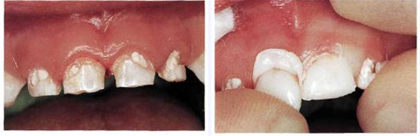 Photo: Restoring teeth with strip crowns