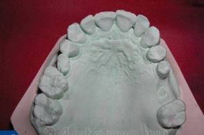 الصورة: نموذج من الجبس الأسنان