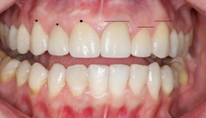 Photo: Perfect condition of the gingival margin