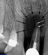 Foto: Tandcyste onder de kroon op de röntgenfoto