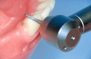Kuva: Hampaan kääntäminen kruunun alla