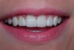 after lengthening the clinical crown of the tooth