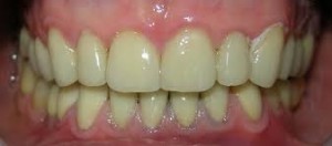 after fixation of temporary crowns