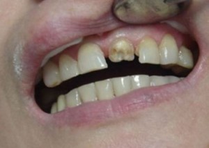 Foto: Dente anterior destruído