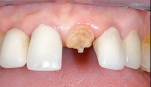 Photo: Tooth restoration with fiberglass pin