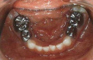 Foto: corones d’acer sobre molars inferiors de llet