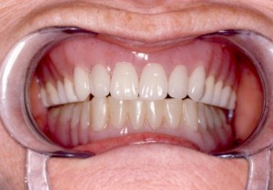 Foto: dissenys de mandíbula extraïbles de silicona superior i inferior