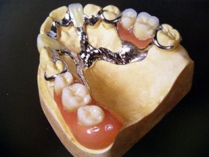 Foto: proteză de închidere pe maxilarul superior