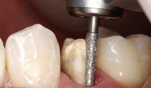 Foto: Slibning af en tand under en krone med en diamantbur