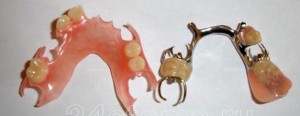 Kuva: Irrotettavat hammasproteesit alaleuassa (nylon vasemmalla) ja lukko oikealla)