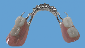 Foto: pròtesi de fermall a la mandíbula inferior