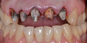 Foto: Verfaulte Zähne unter Kronen