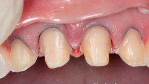 Fotografie: Přední zuby s římsou