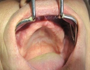 الغياب التام للأسنان في الفك العلوي